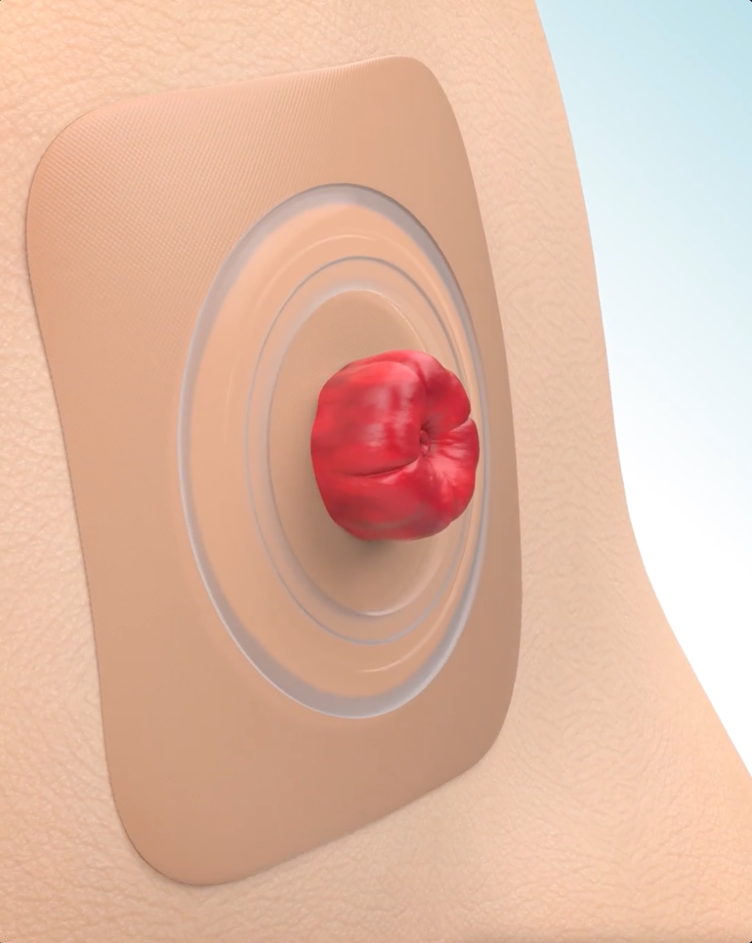 Convatec 접착제의 작동 원리를 보여주는 동영상