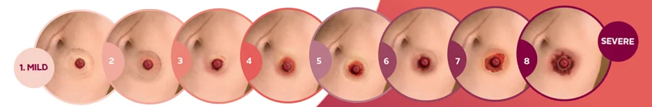 Estágios de problemas de pele periestomal.