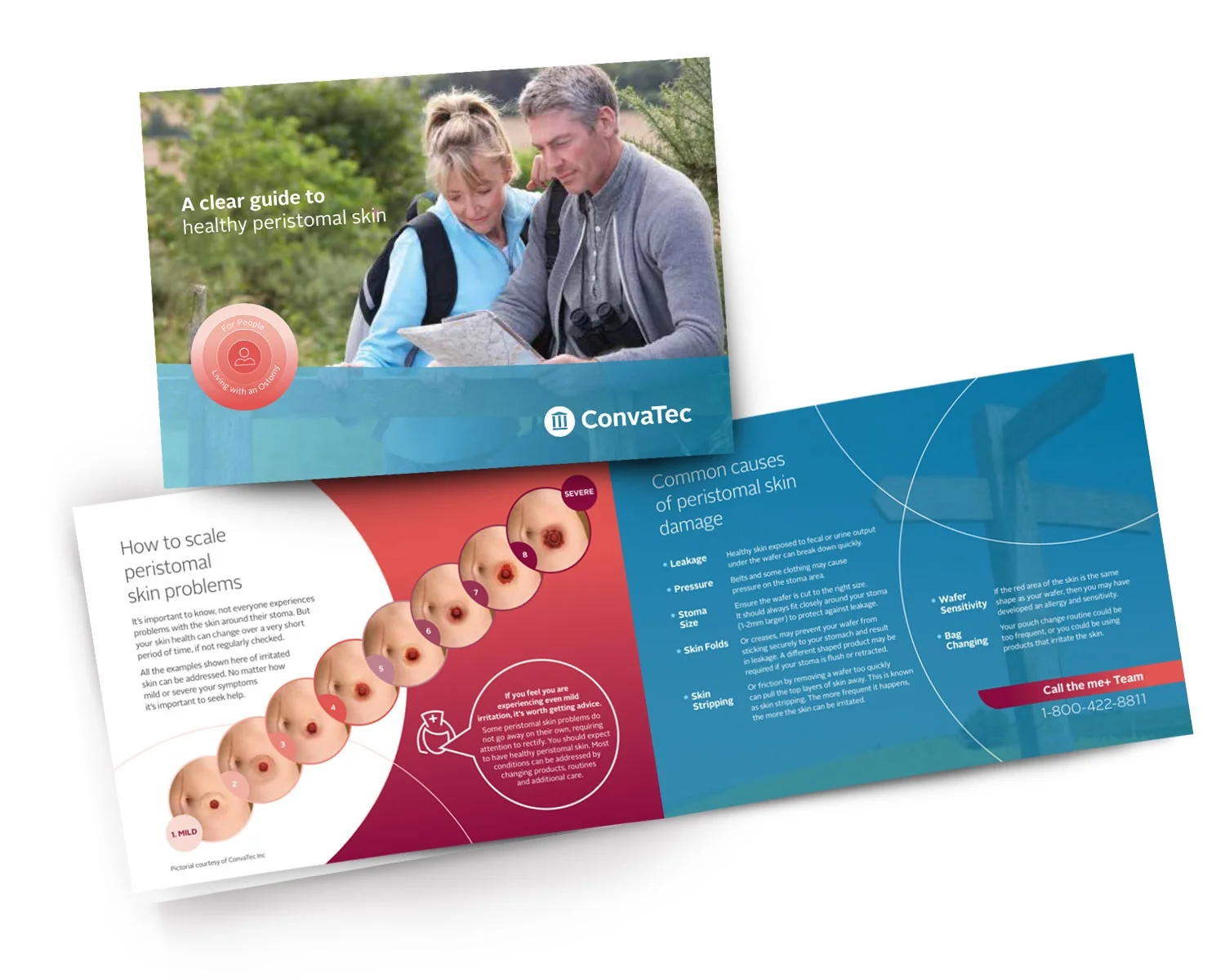 Een omslag van de brochure: 'Clear Guide to Healthy Peristomal Skin' gaat dieper in op schilferingsproblemen en veelvoorkomende oorzaken van huidbeschadiging.